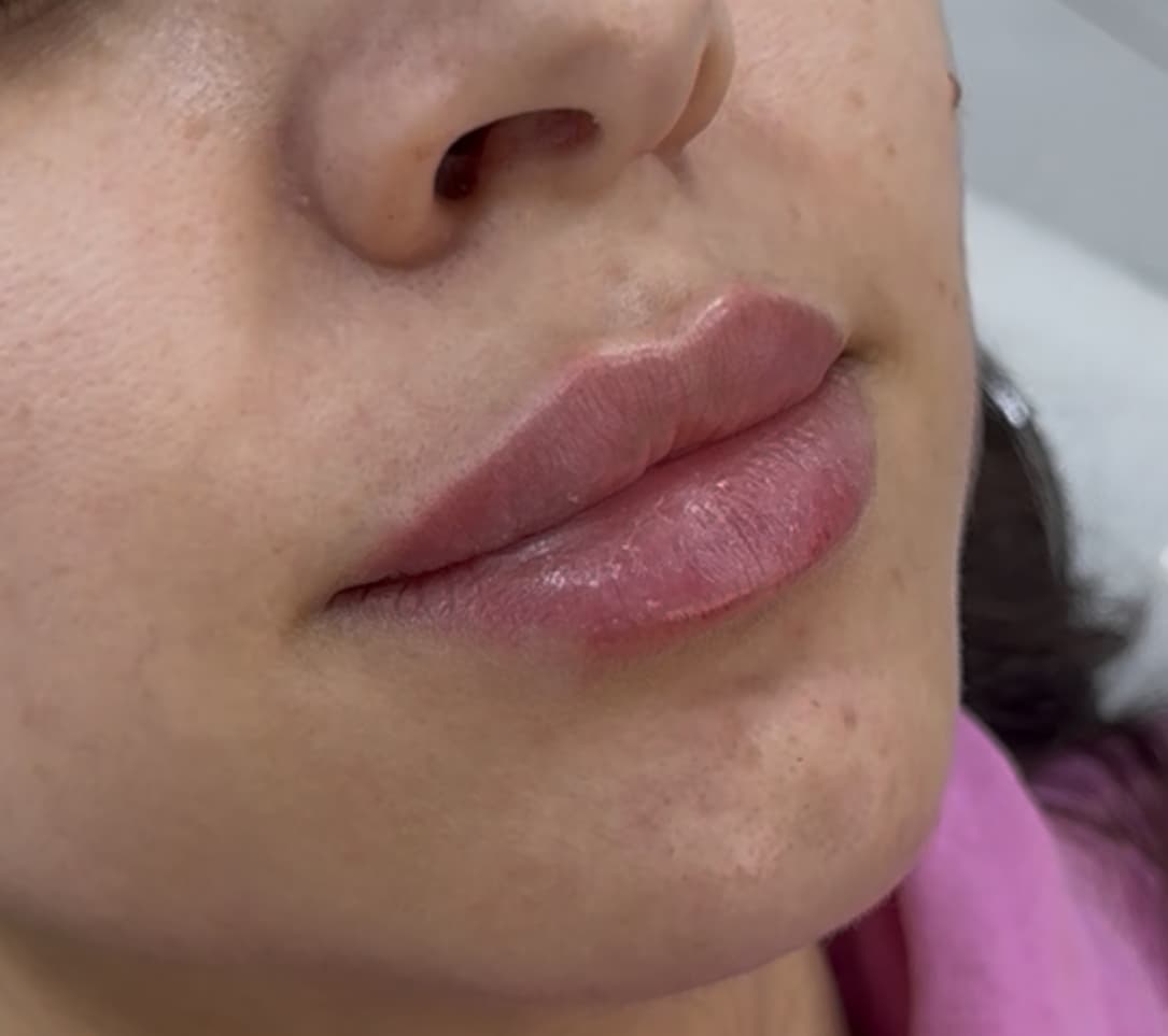 Lip filler treatment example two