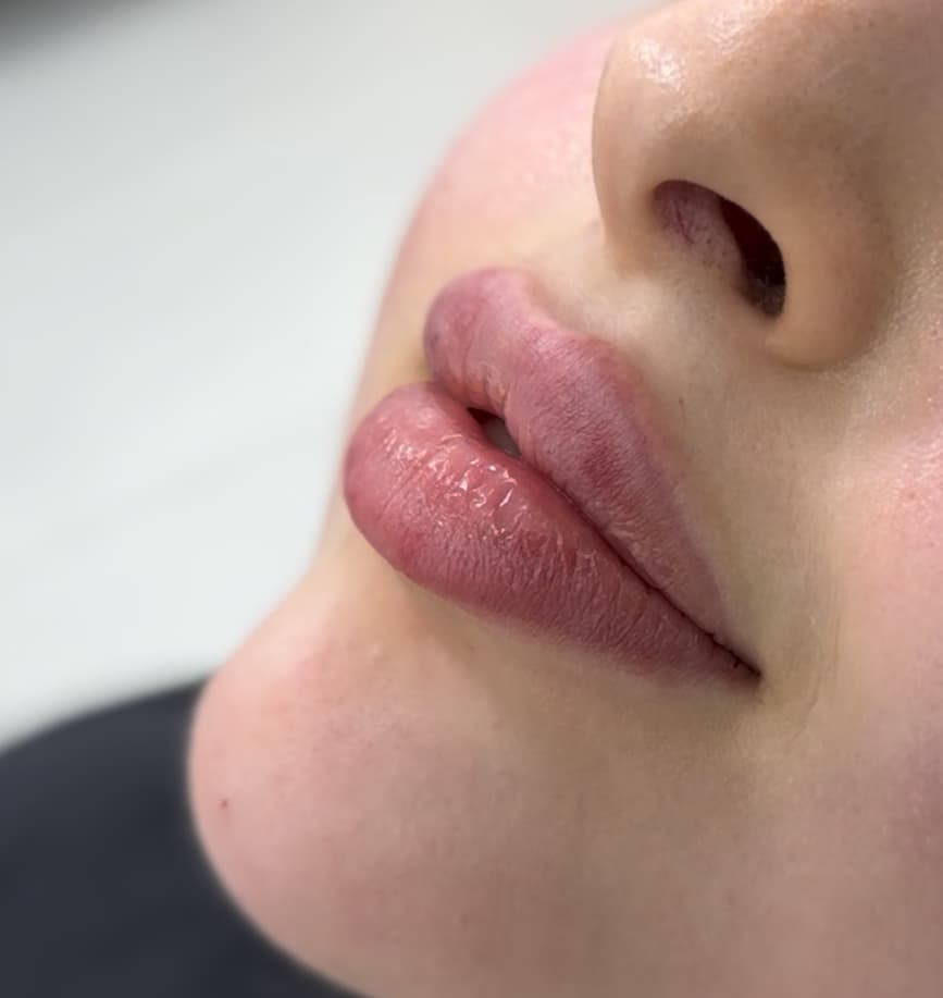 Lip filler treatment example three